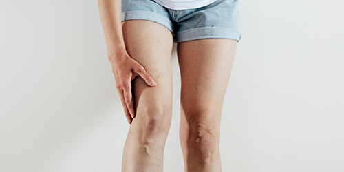 Отеки ноги: причины, симптомы и лечение