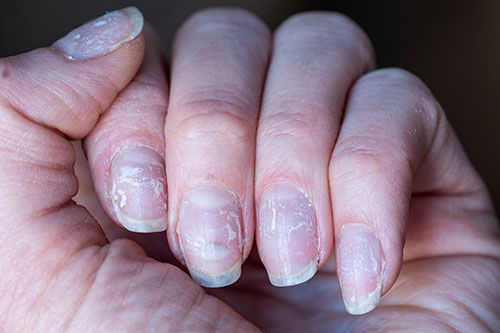 Эффективное лечение грибка кожи и ногтей