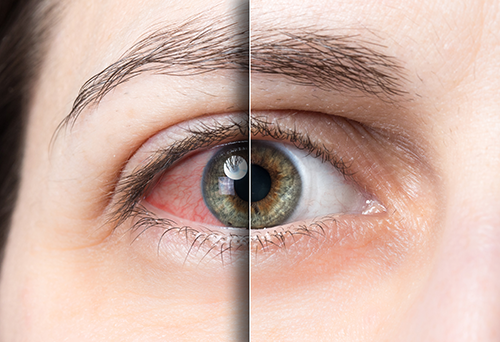 Покраснение глаз: 19 причин возникновения и способы лечения